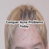 Conquer Acne Problems Today problems in haiti today 