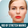 How To Get Rid Of Stretch Marks - Get Rid of Stretch Marks after Pregnancy