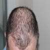Hair Loss Treatment #1 Hair Loss Cure & Care hair care routine 
