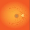 Vasculitis retiniana